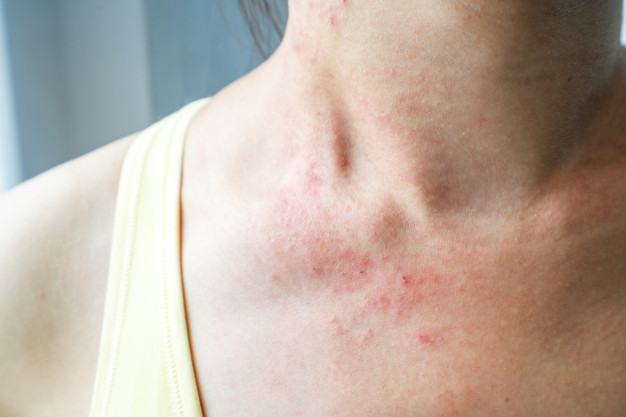 5 Pemicu Kulit Sensitif dan Cara Perawatannya